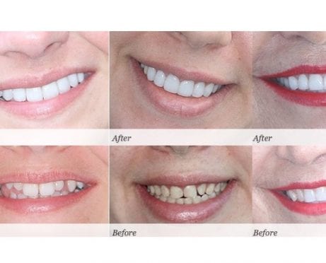 Smile Like You Paid for It! The Cost of Teeth Whitening